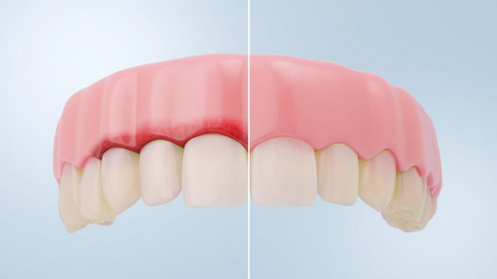 Gingivitis: la amenaza silenciosa que puede poner en riesgo tu salud&nbsp;bucodental